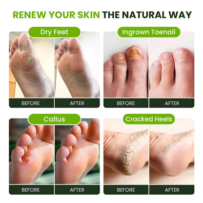 FOOT CURE Tea Tree Oil Foot Soak with Epsom Salt – Spa Foot Bath for Calluses, Odor & Tired Feet (Pack of 2)
