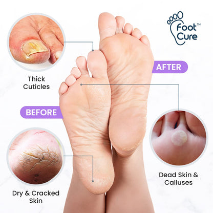 FOOT CURE Lavender Foot Soak & Callus Remover Gel Kit | Extra-Strength Foot Care for At-Home Pedicures