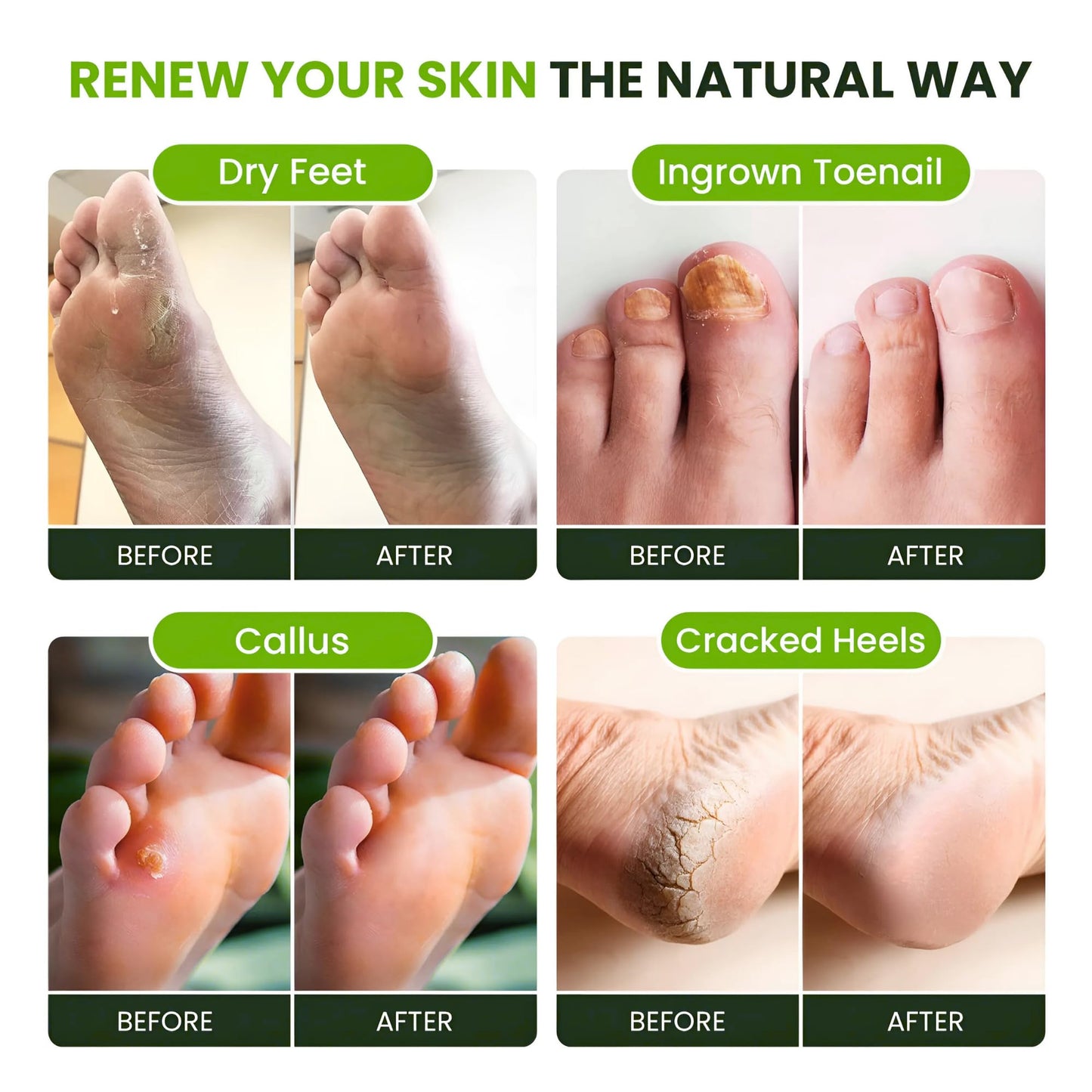 FOOT CURE Tea Tree Oil Foot Soak with Epsom Salt | Soothes Feet, Softens Calluses, Odor Control | Made in USA 16 oz