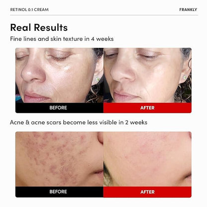 FRANKLY Retinol 0.1% Cream – Beginner Night Cream with Ceramides & Ginseng