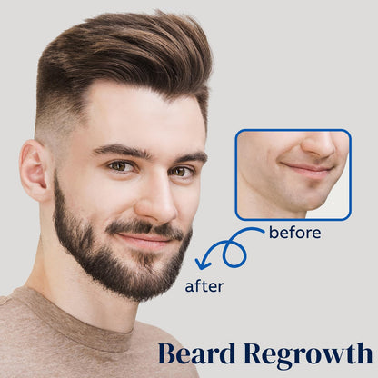 FUZYAT 5% Minoxidil Hair Growth Spray for Men & Women – 2-Pack