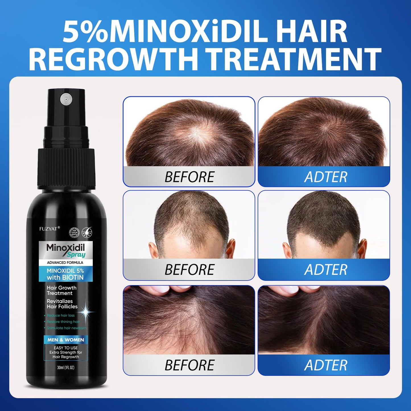 FUZYAT 5% Minoxidil Spray Kit – Hair Growth for Men & Women, 2-Pack