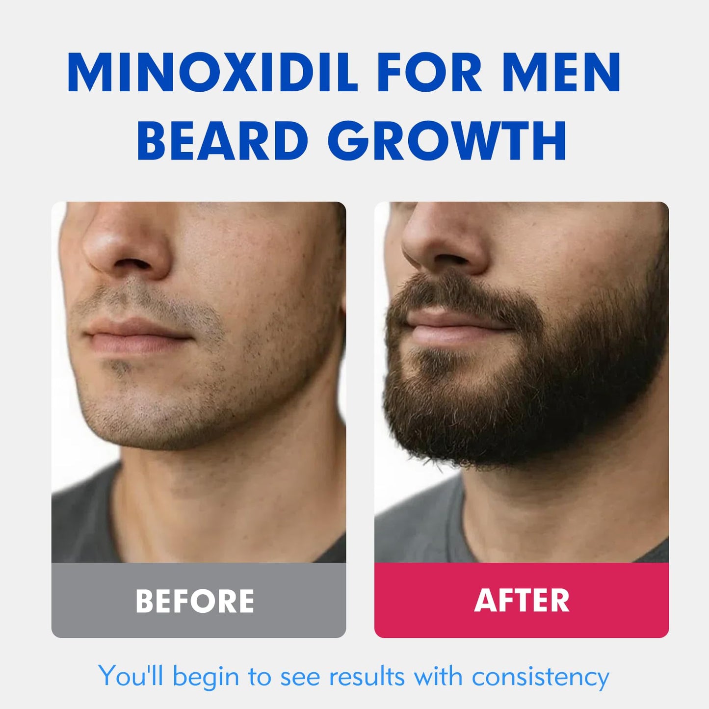 Fyntikal 5% Minoxidil for Men – Hair Regrowth & Beard Growth, 4-Pack 240ml