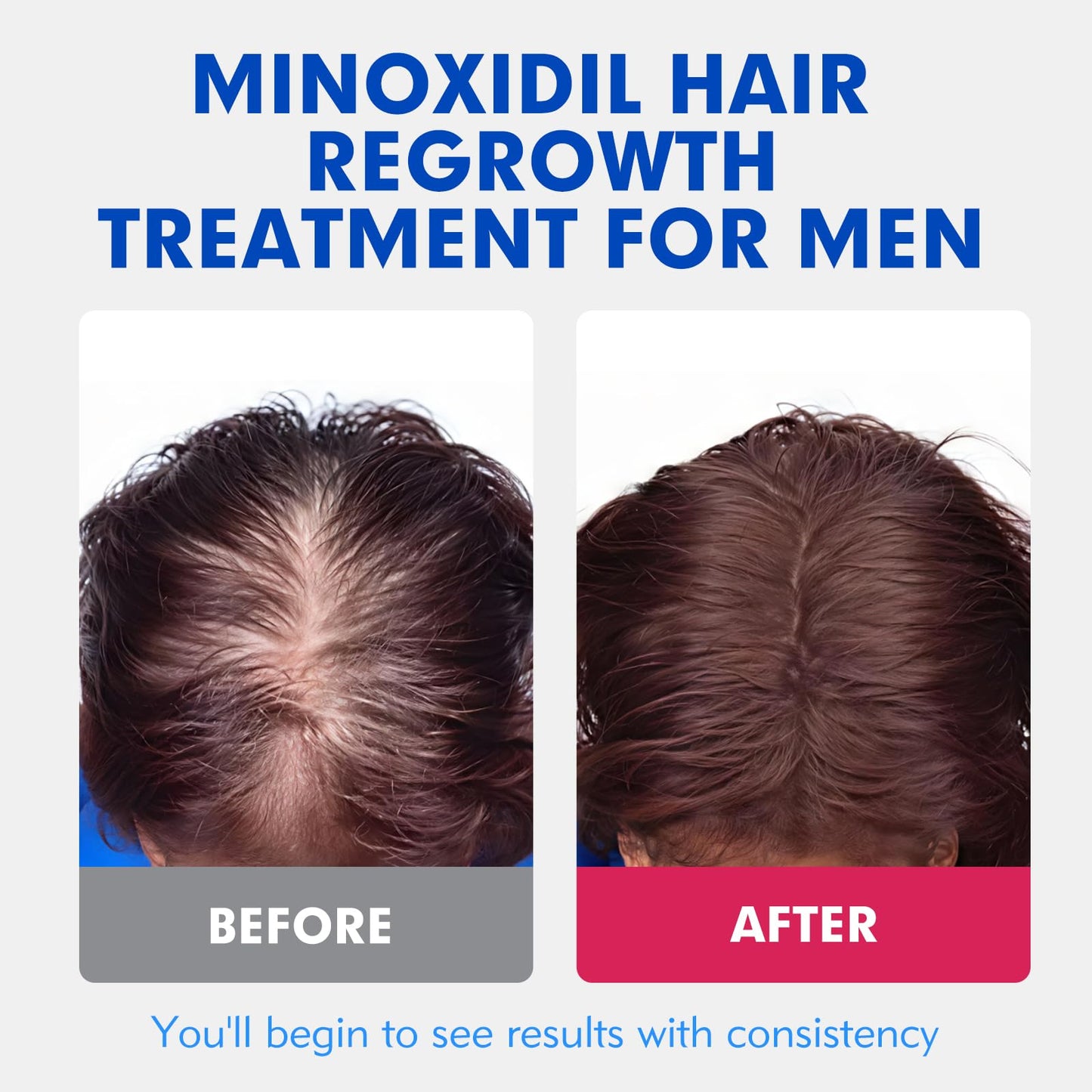 Fyntikal 5% Minoxidil for Men – Hair & Beard Growth, Non-Greasy Topical Solution, 3-Month Supply