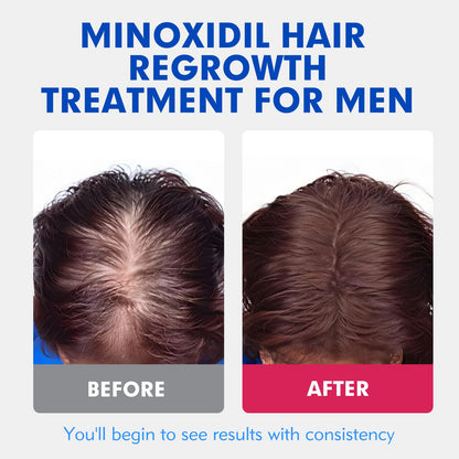 Fyntikal 5% Minoxidil for Men – Extra Strength Hair & Beard Growth Serum (2-Pack)