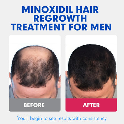 Fyntikal 5% Minoxidil for Men – Extra Strength Hair & Beard Growth Serum (2-Pack)