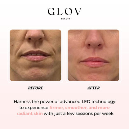 Glov Beauty LED Face Mask – Red Light Therapy for Firmer, Smoother Skin