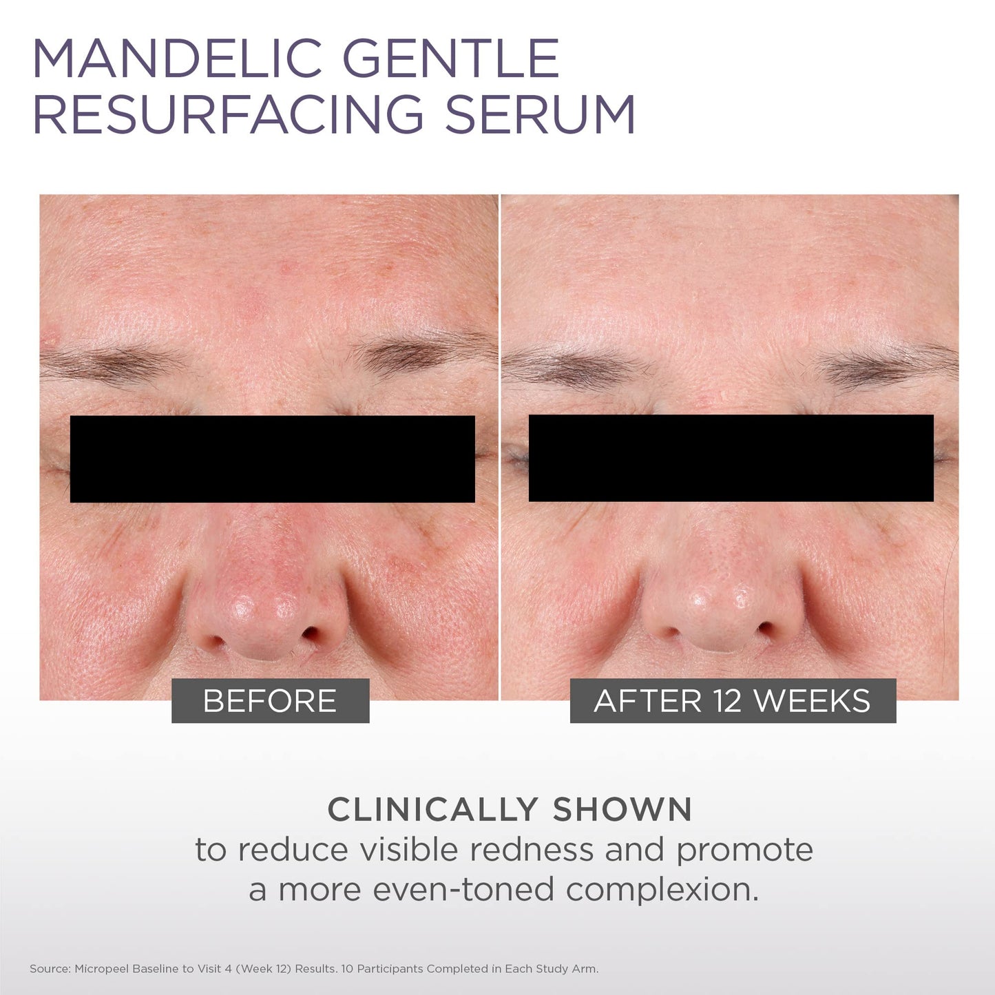GLYTONE Micro-Peel Mandelic Serum 10% | Gentle AHA Exfoliant for All Skin Types