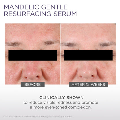 GLYTONE Micro-Peel Mandelic Serum 10% | Gentle AHA Exfoliant for All Skin Types