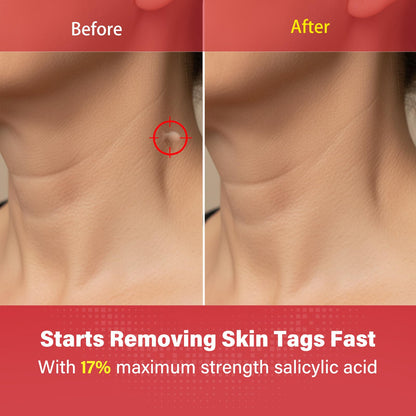 Goodnites Skin Tag Remover – Fast-Acting Gentle Salicylic Acid Formula for Neck, Underarms, Groin | 112 PCS