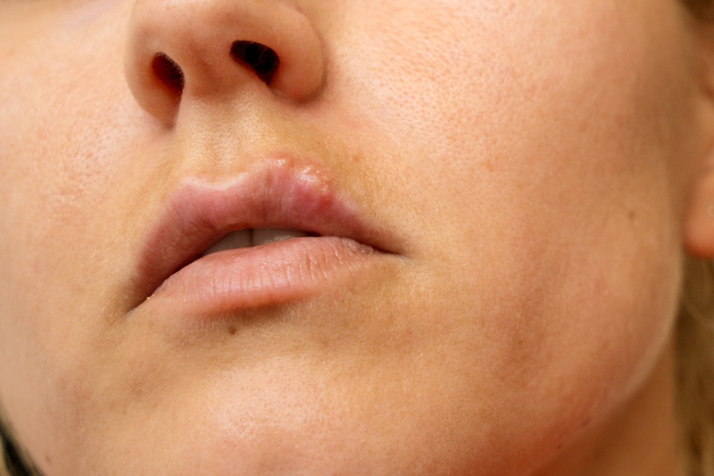 Herbal Lip Oil Lotion for Cold Sore Relief – Soothing Invisible Natural Lip Treatment