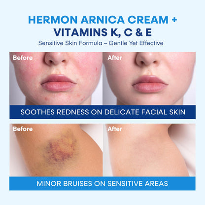 Hermon Arnica Bruise Cream with Vitamin K – Sensitive Skin & Face Formula, Extra Strength Hydrating Moisturizer 2 Oz