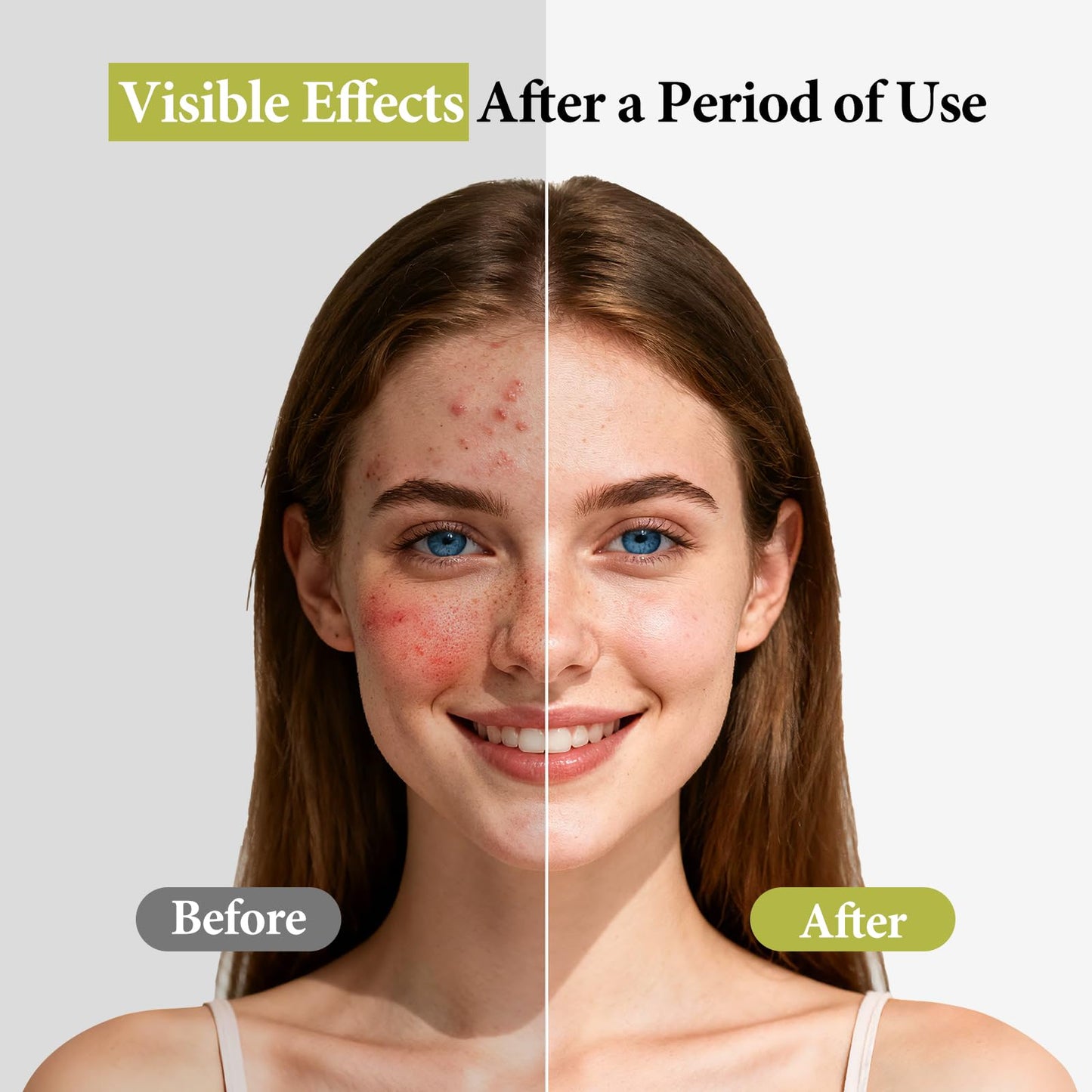 Hyuxeo Salicylic Acid Serum – Acne & Pore Minimizing | Glycolic + Witch Hazel