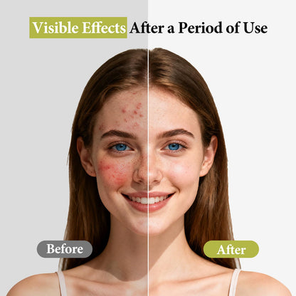 Hyuxeo Salicylic Acid Serum – Acne & Pore Minimizing | Glycolic + Witch Hazel