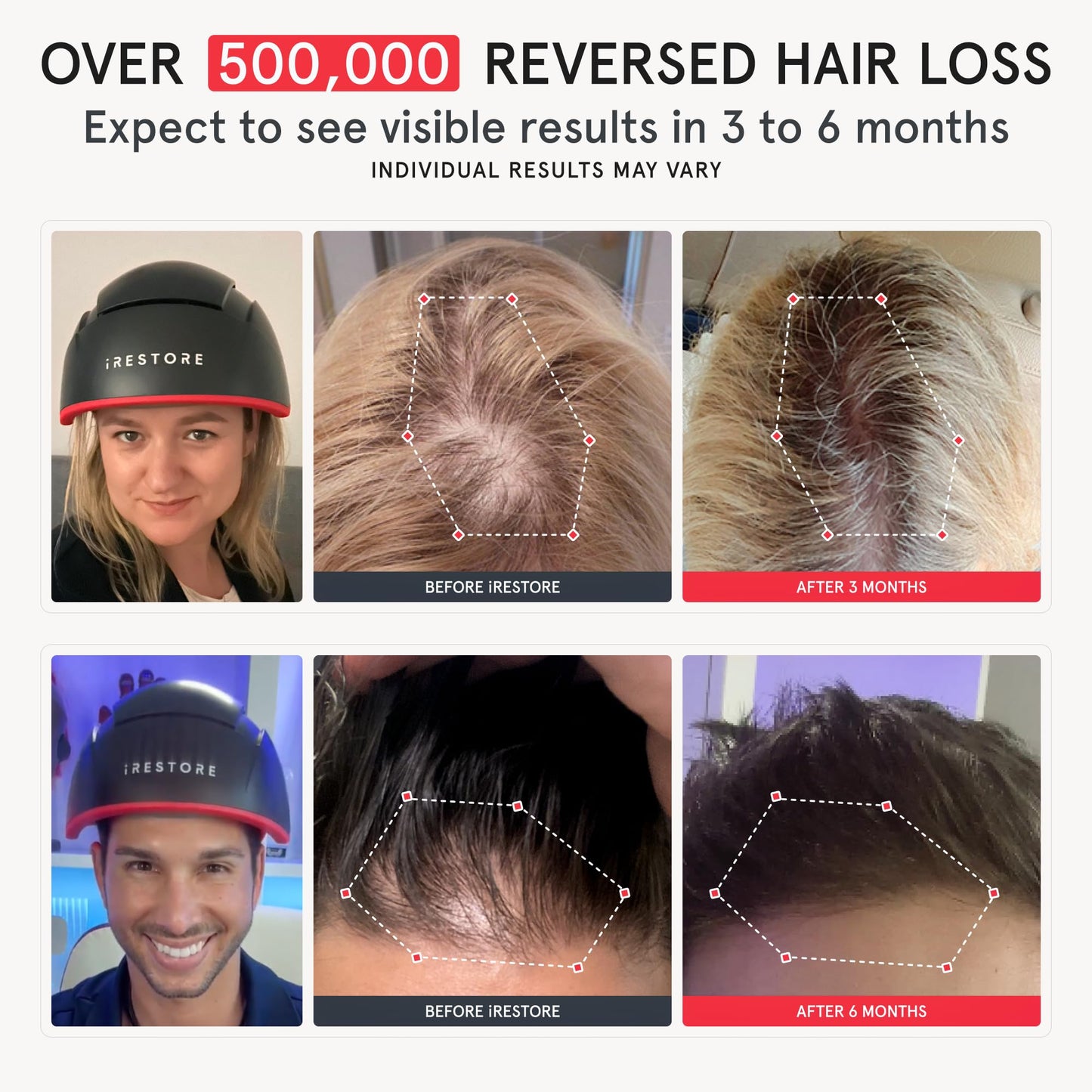 iRestore Elite + Rechargeable Battery Pack | Hair Growth Laser Cap (500 Lasers & LEDs) | FDA Cleared
