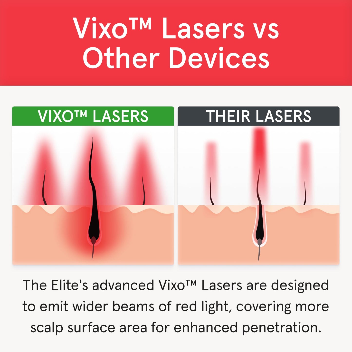 iRestore Elite Laser Hair Growth System – FDA-Cleared Home Treatment with 500 Lasers & LEDs