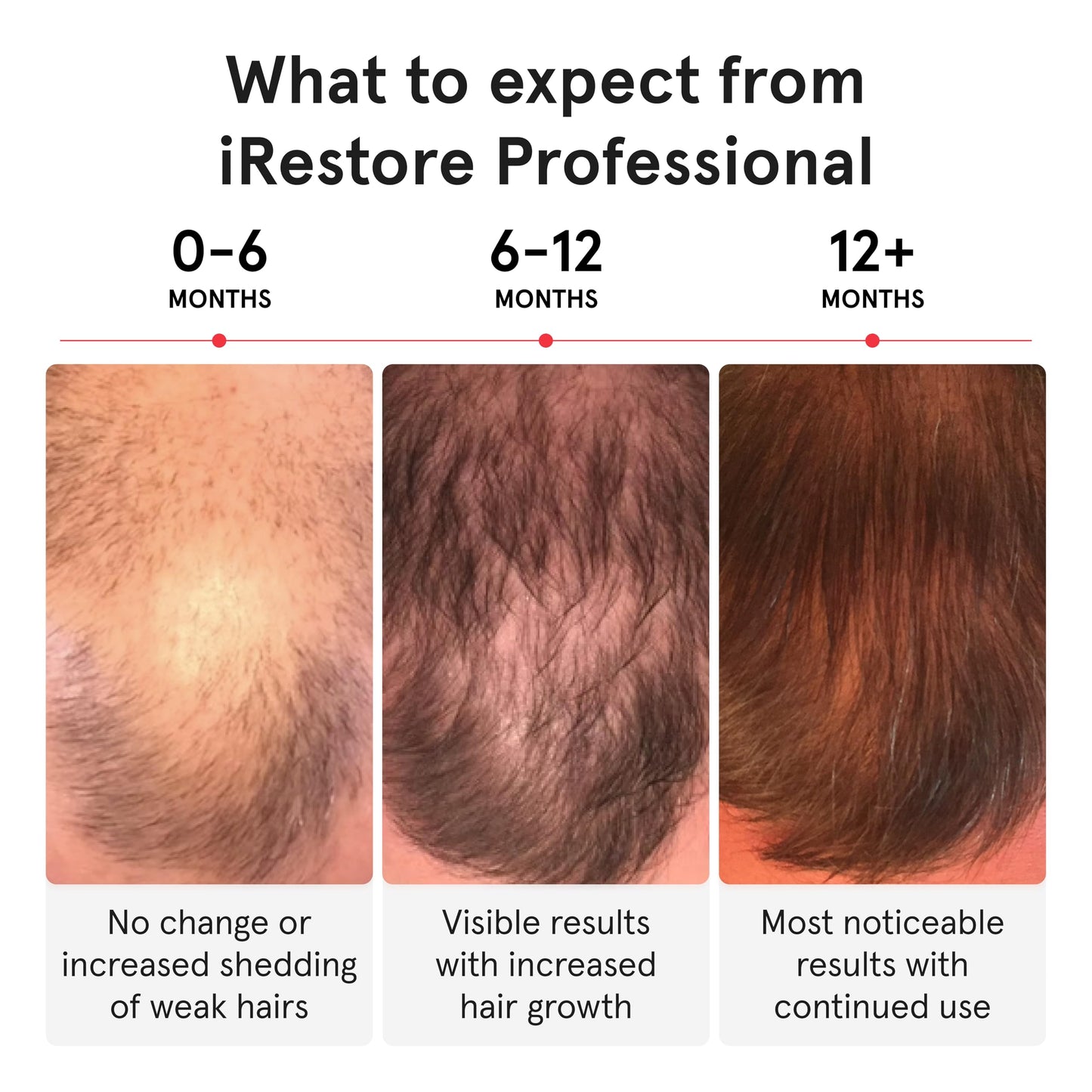 iRestore Pro + Rechargeable Battery Pack – 282 Lasers & LEDs Red Light Therapy for Hair Growth (FDA Cleared)