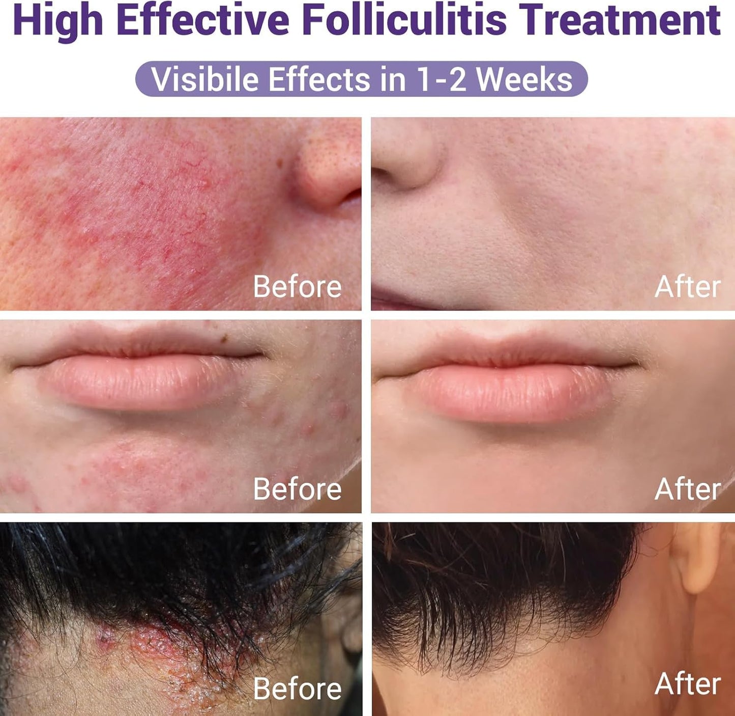 ishancare Folliculitis Treatment Cream – Natural Relief for Itching, Redness & Inflammation | 3.53 Oz