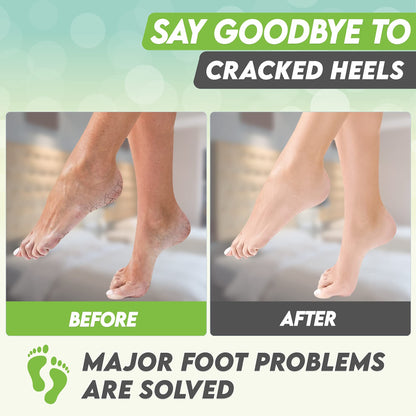 Karma Organic Foot Peel Mask - Green Tea Exfoliating Foot Masks (Pack of 2)