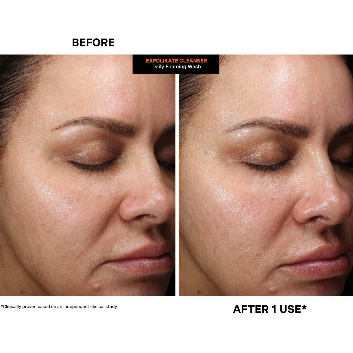 Kate Somerville ExfoliKate Cleanser: Daily Exfoliating Foaming Face Wash with Glycolic & Lactic Acids (8 oz)