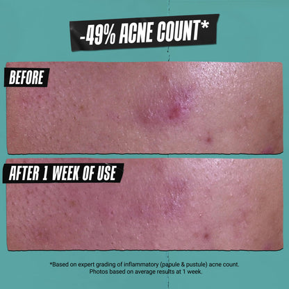 Kiehl's Acne-Treating Cleansing Paste – 3-in-1 Cleanser, Spot Treatment & Face Mask