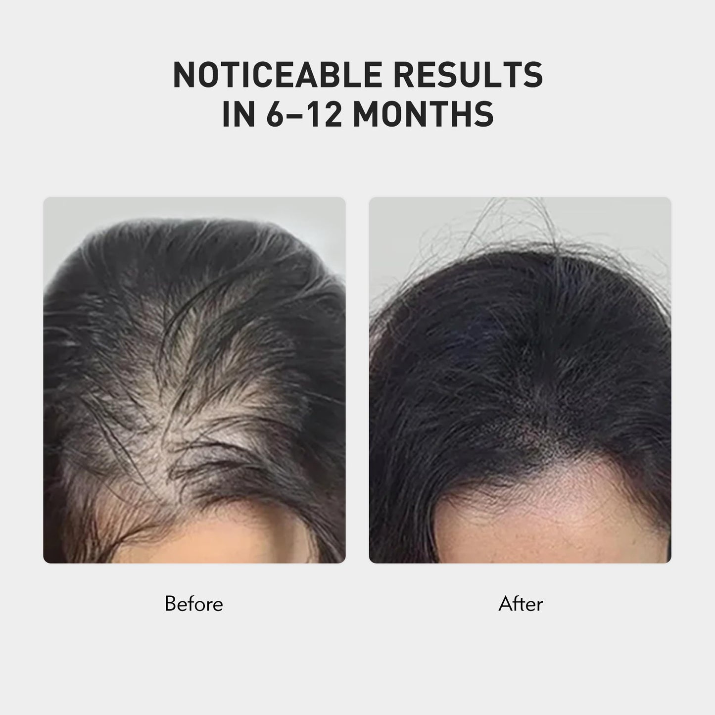 KINTOR 0.9% KX-826 Hair Regrowth Spray – Supports Healthy Hair Growth & Oil Control | 60ml