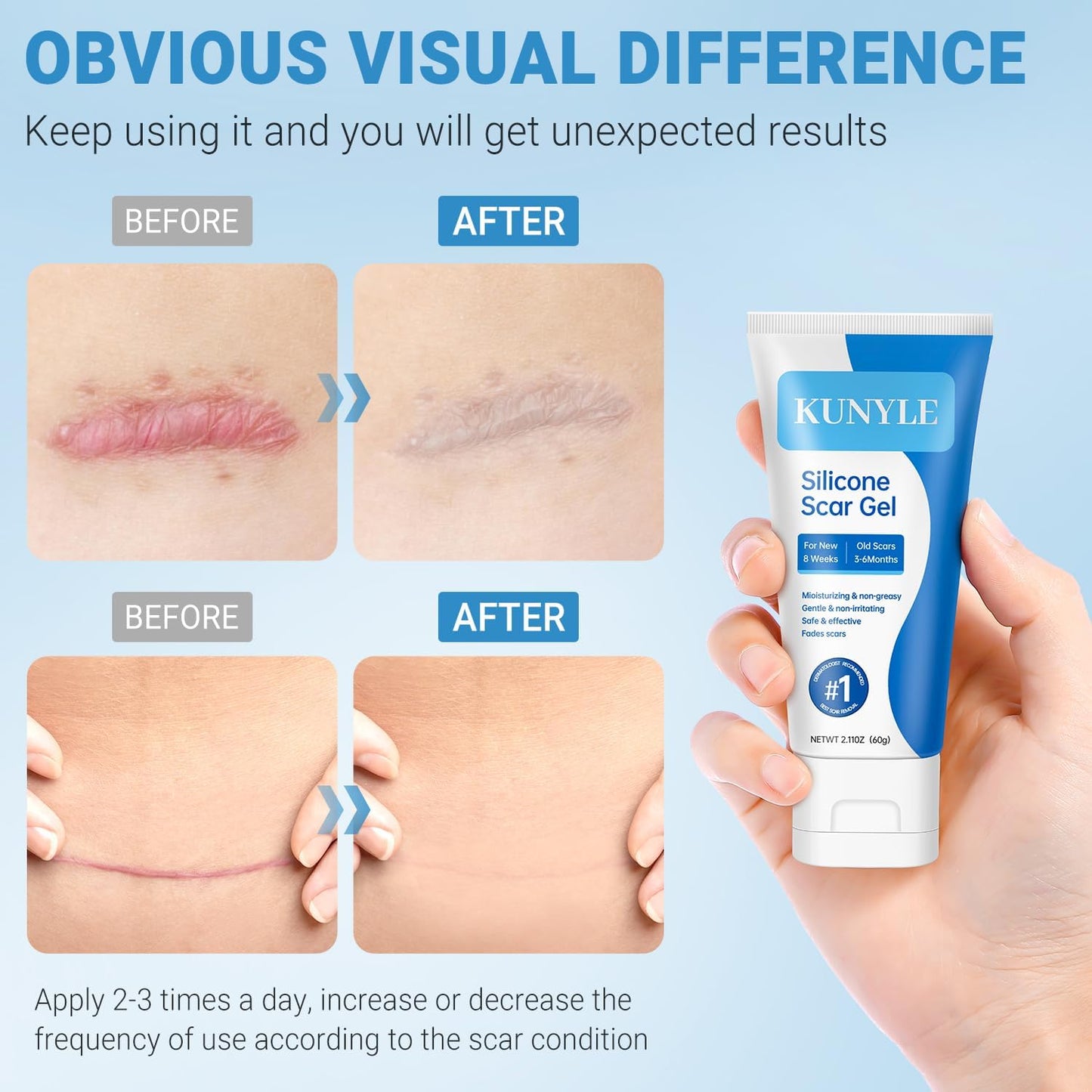 Kunyle Silicone Scar Gel – Advanced Scar Cream for Surgical Scars, Stretch Marks & Keloids | 2.11oz