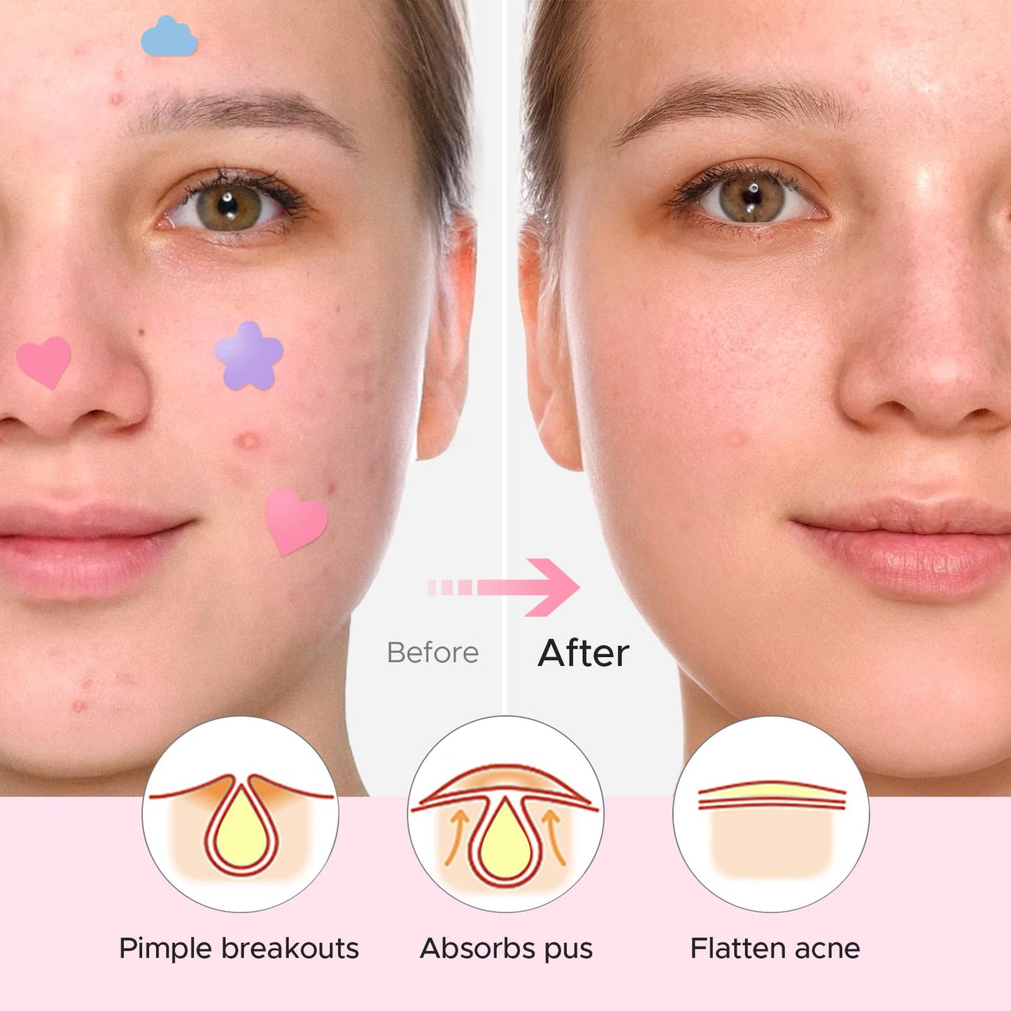 LitBear Acne Pimple Patch – 360 Dots, 3 Shapes, Salicylic Acid, Tea Tree & Calendula