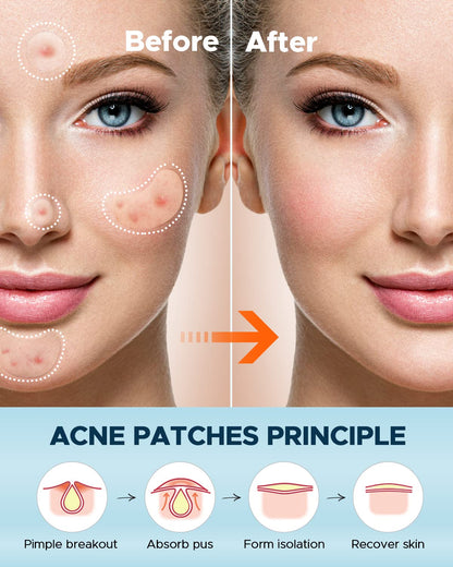 LitBear Large Acne Pimple Patches – 100 Patches, 6 Sizes, Tea Tree & Calendula, Hydrocolloid for Face & Body