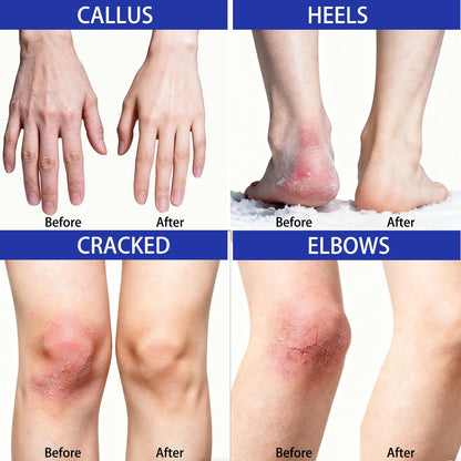 LOLX Urea Cream 40% + Salicylic Acid 2% – Deep Hydration for Feet and Dry Skin (5.29 oz)