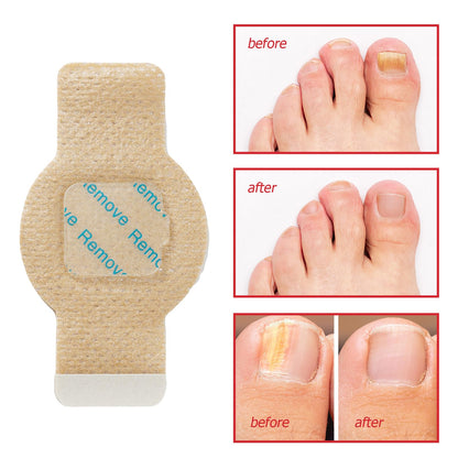 LTQXGT Fungal Nail Patches – Extra Strength Toenail Patches (21 Pcs)