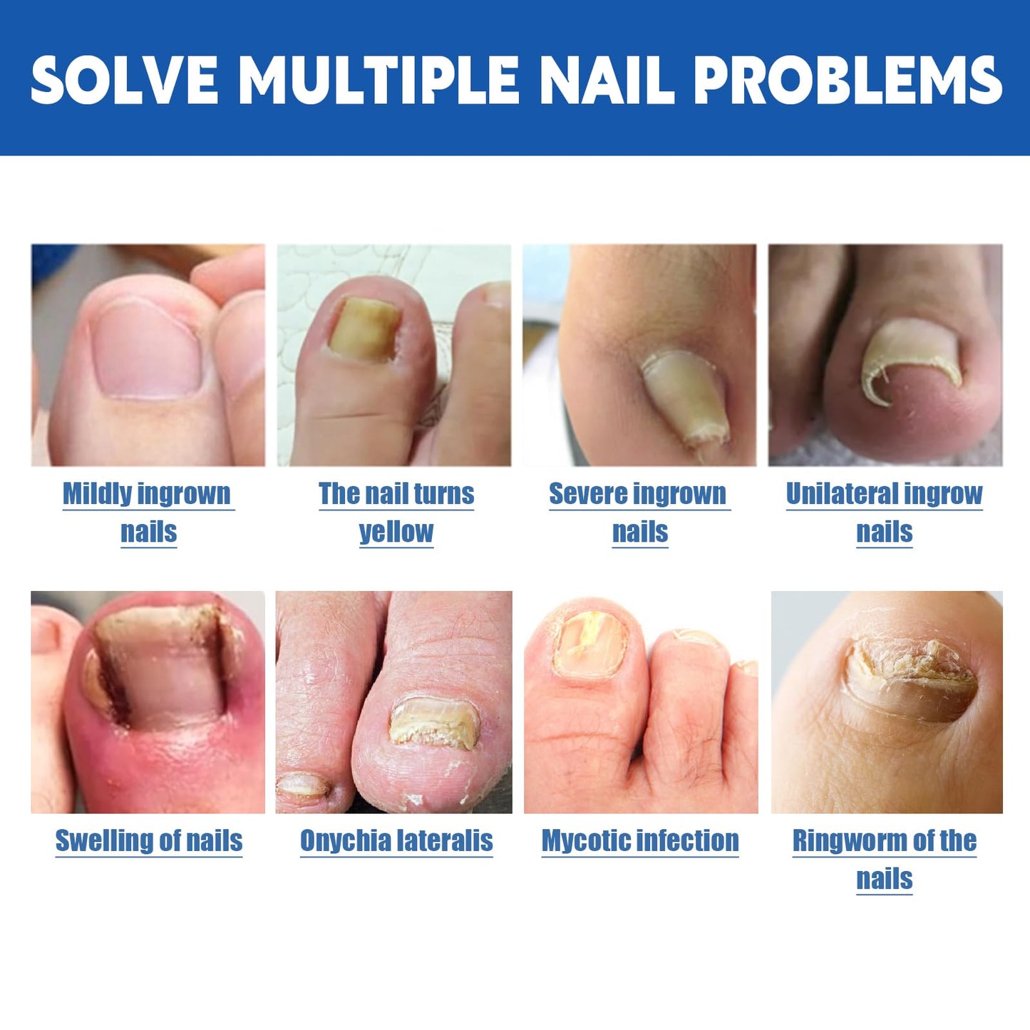 LYFXuGeMLM 20 Patches Fungal Nail Repair – Toenail Restoration, 8-Hour Intensive Treatment