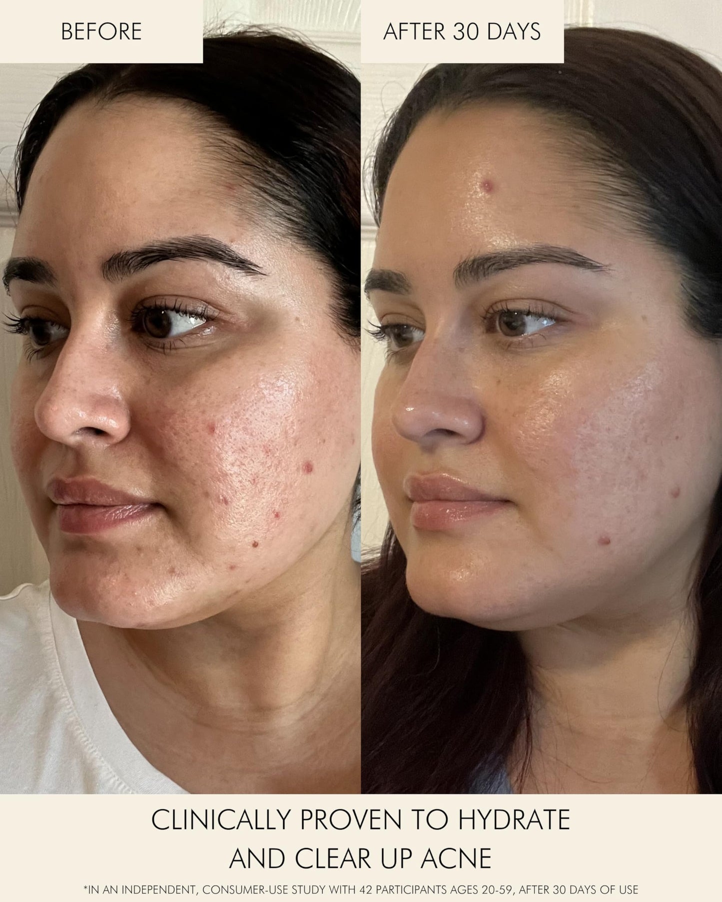 MARA Clear Skin Mineral Milk Hydrating Acne Treatment with Niacinamide + Copper | BHA Serum for All Skin Types (1 oz / 30 ml)