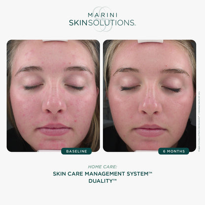 Marini SkinSolutions Duality: Benzoyl Peroxide 10% + Retinol Acne & Anti-Aging Cream
