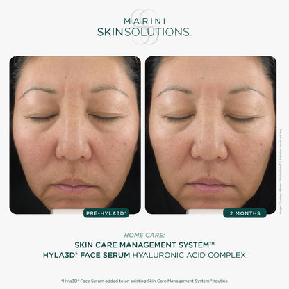 Marini SkinSolutions Hyla3D Face Serum – Patented HA Hydration for All Skin Types