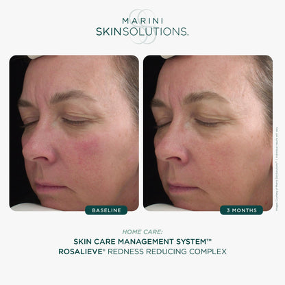 Marini RosaLieve - Redness Reducing Face Lotion with Azelaic Acid & Tetrapeptide-14