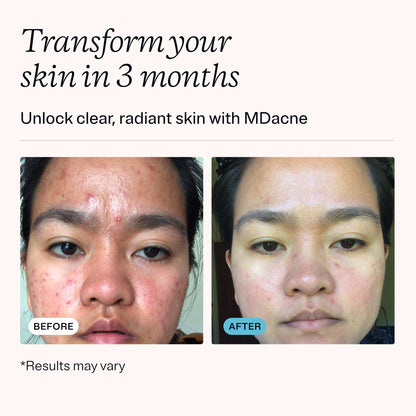 MDacne 3 Step Acne Treatment Kit – Benzoyl Peroxide 2.5%, Salicylic Cleanser, Niacinamide Moisturizer