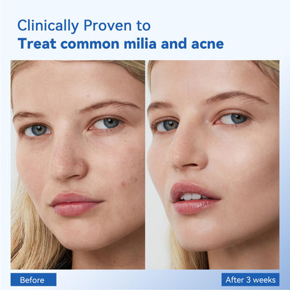 MEOLY Milia Remover with Salicylic Acid – Milia Spot Treatment for Eyes & Face | 30 ml