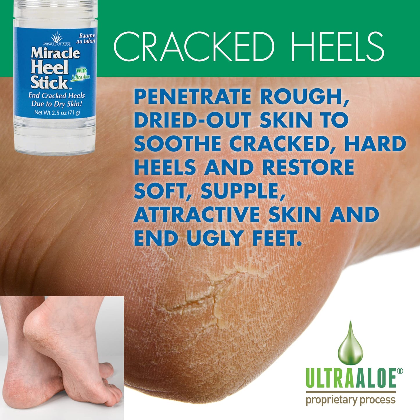 Miracle of Aloe Heel Balm Stick with Gel Socks – Soothe Dry, Cracked Heels