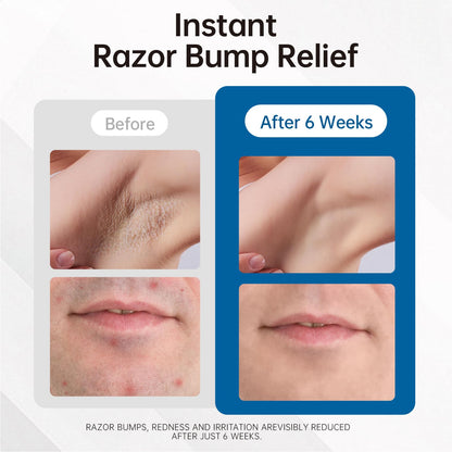 Morovan Razor Bumps & Ingrown Hair Serum — 3.38 fl oz for Body, Face (Beard), Bikini | Post-Shave & After-Wax Care