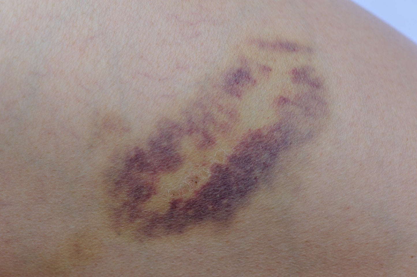 Natural Handmade Arnica Oil for Massage and Bruising - Relief and Healing Oil
