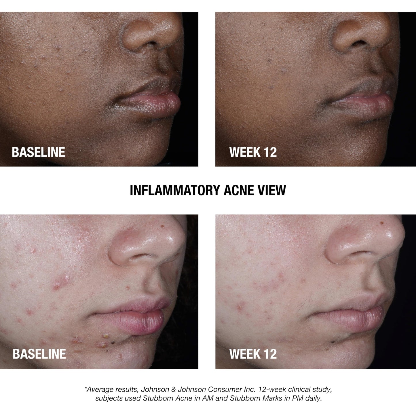 Neutrogena Stubborn Acne AM Treatment | 2.5% Benzoyl Peroxide, Oil-Free
