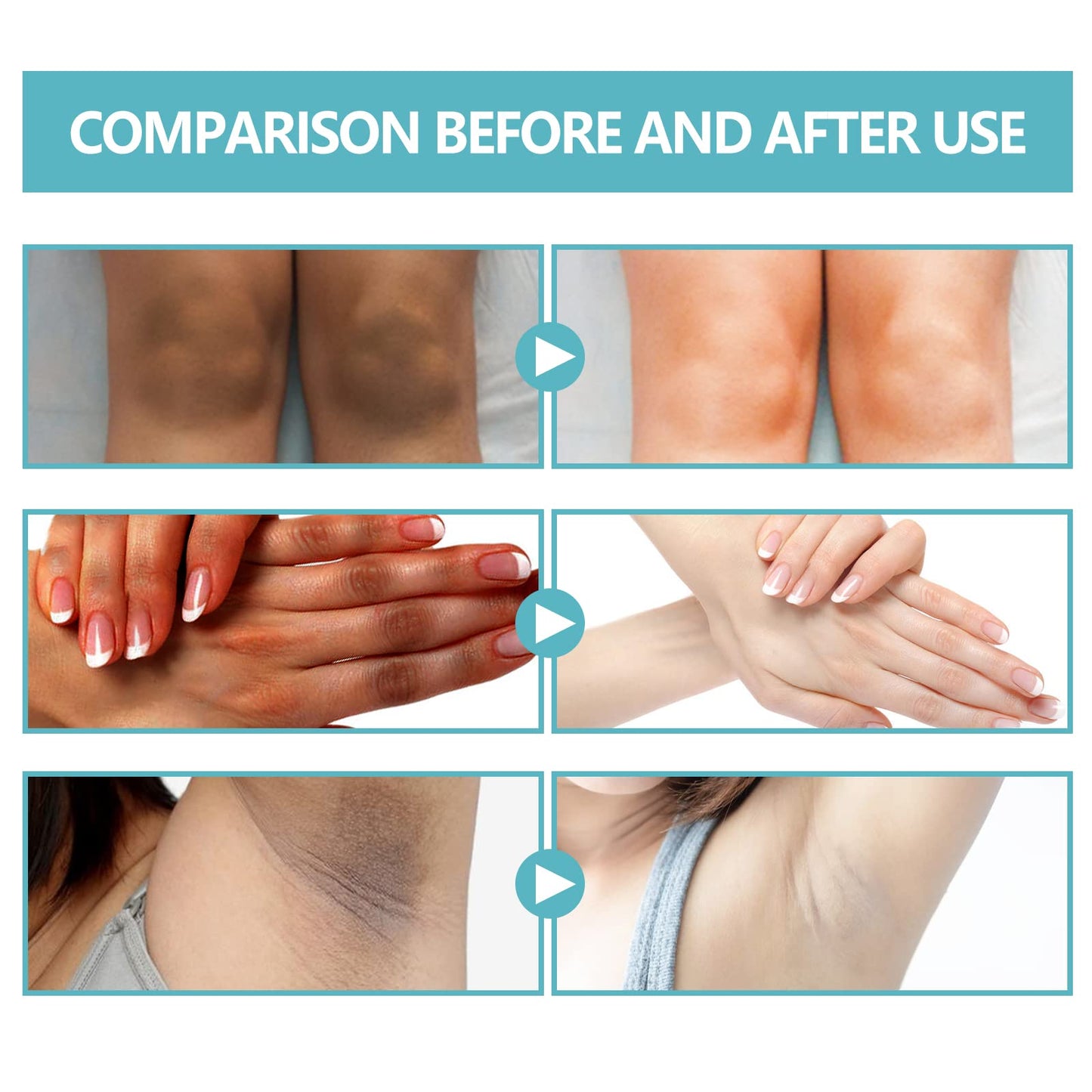 Nigrifix Acanthosis Nigricans Therapy Cream – Dark Spot Corrector for Body | Underarms, Neck & More | 2.1 Fl Oz