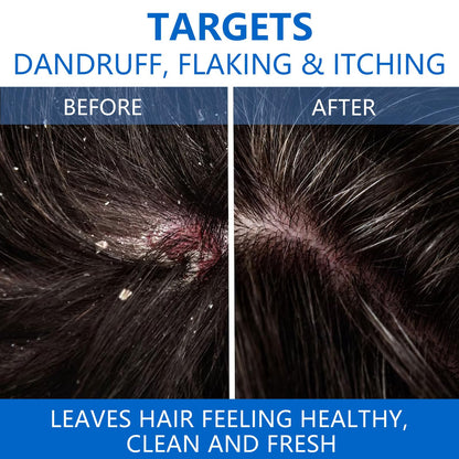 NIPPORI 300ML Selenium Disulfide Anti-Dandruff Shampoo - Oil Control for Men & Women