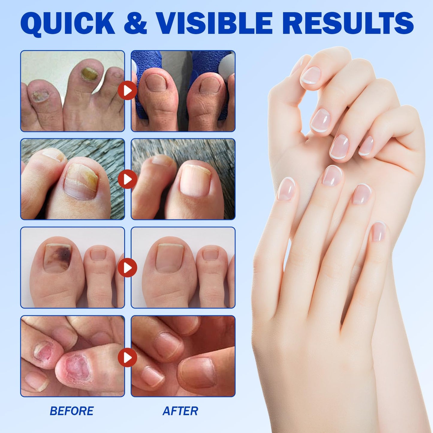 Nyloriaine Fungal Nail Patches - Extra Strength Toe Nail Repair (21p)