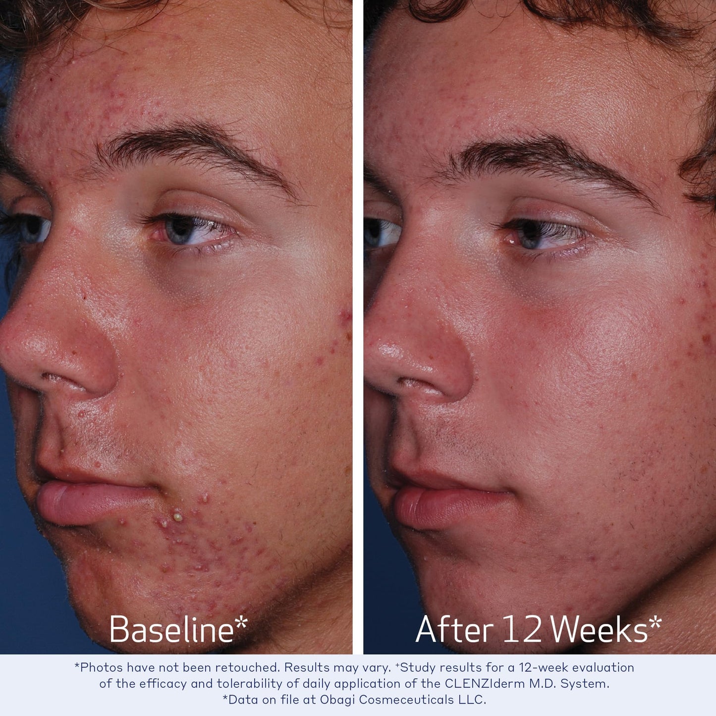 Obagi CLENZIderm M.D. Therapeutic System – 3 Step Acne Treatment with 2% BHA Cleanser, 2% BHA Toner, 5% BPO
