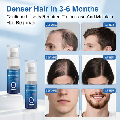 OCVWJKD 5% Minoxidil Spray for Hair Regrowth — Extra Strength 60ml x 7 Bottles