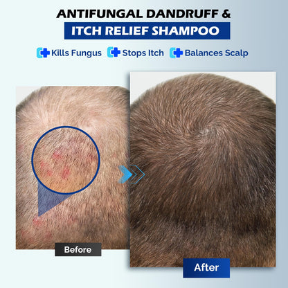 Oely Anti-Dandruff Shampoo for Folliculitis & Scalp Psoriasis | 10.1 fl oz