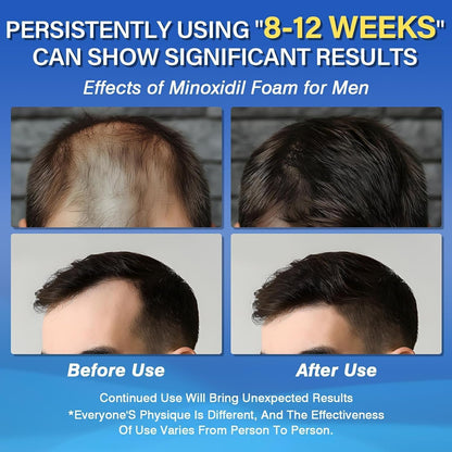Olassubd Minoxidil 5% Foam for Men – Hair Growth Foam (3 Bottles, 2.11 oz Each)