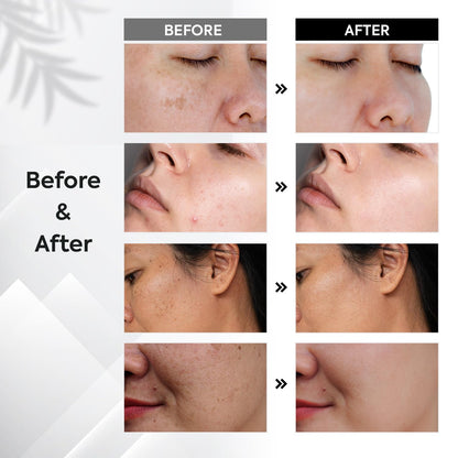 Oudetas Dark Spot Remover for Face – Brightening Serum Roller (15ml) for Sun, Age Spots & Melasma